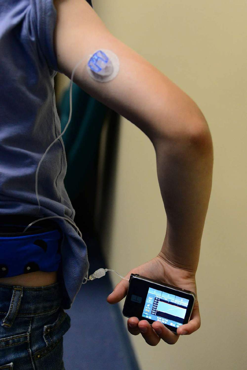 Could an Insulin Pump be the perfect accessory?